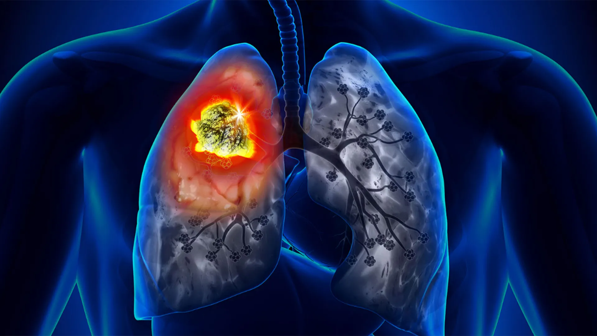 ফুসফুসের ক্যানসার: জানুন ৪টি জরুরি তথ্য