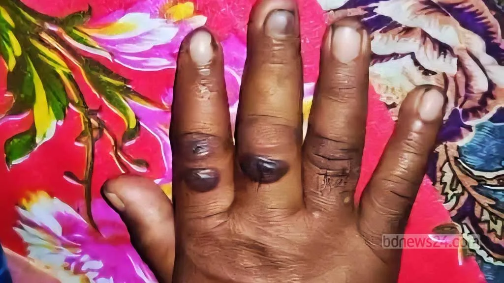 গাইবান্ধায় রোগাক্রান্ত গরু কাটাকাটি করা ১১ জনের দেহে ‘অ্যানথ্রাক্স উপসর্গ’