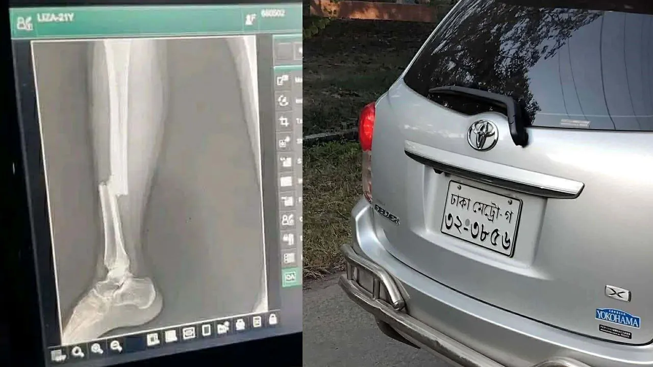 রাবিতে শিক্ষকের গাড়ির ধাক্কায় ইতিহাস বিভাগের ছাত্রী আহত, পা ভেঙেছে